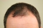 FUE (Follicular Unit Excision)