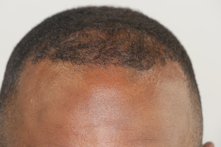 FUE (Follicular Unit Excision)