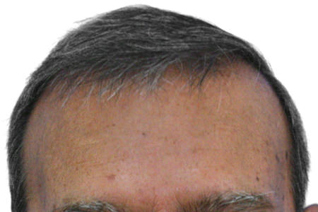 FUT Hair