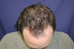 FUT Hair