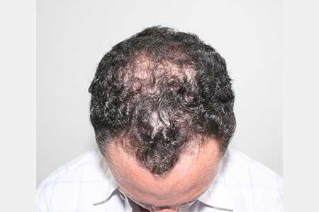 FUT Hair