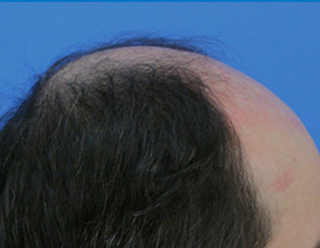 FUT Hair