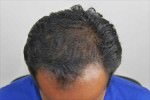 FUT Hair