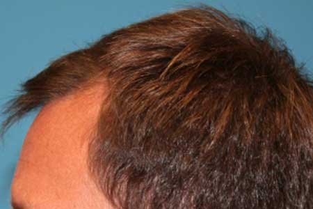 FUT Hair