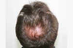 FUT Hair