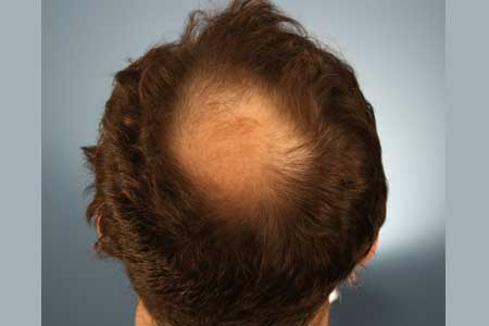 FUT Hair