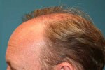 FUT Hair