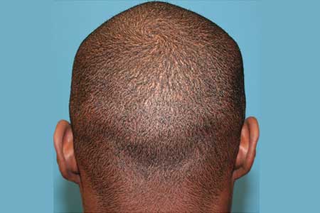 FUE (Follicular Unit Excision)