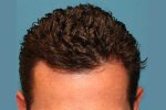 FUE (Follicular Unit Excision)