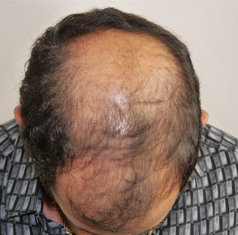 FUT Hair