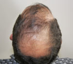 FUT Hair
