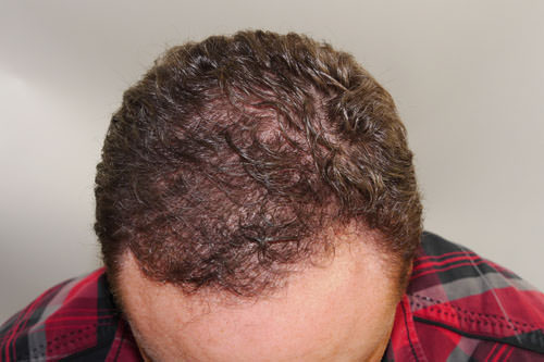 FUT Hair