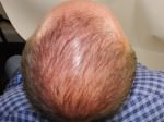FUT Hair