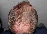 FUT Hair