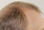 FUT Hair