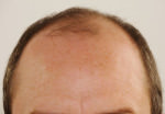 FUT Hair