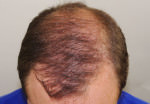 FUT Hair