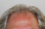 FUE (Follicular Unit Excision)