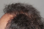FUT Hair