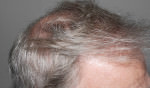 FUT Hair