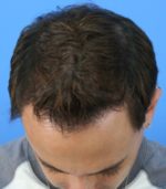 FUT Hair