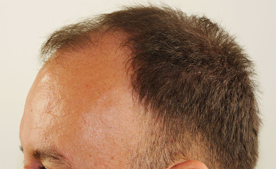 FUT Hair