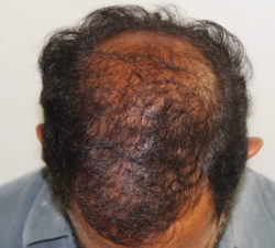 FUT Hair