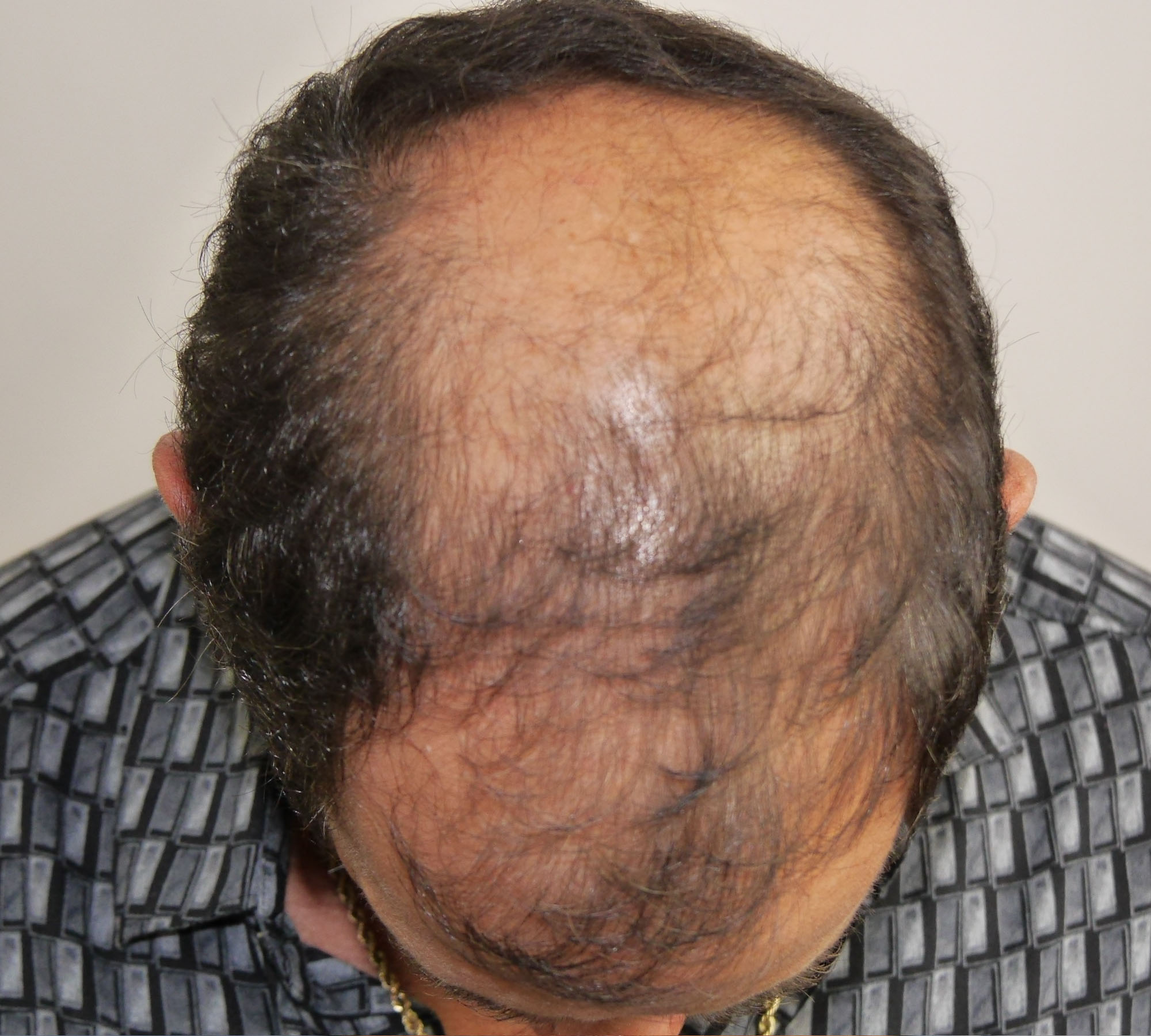 FUT Hair