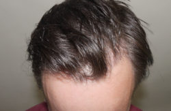FUT Hair