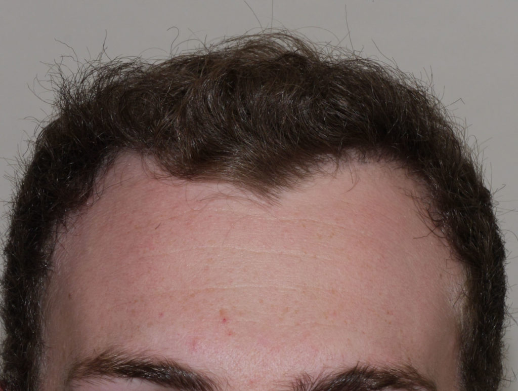 FUE (Follicular Unit Excision)