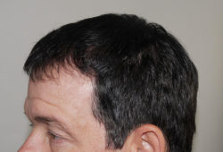 FUT Hair