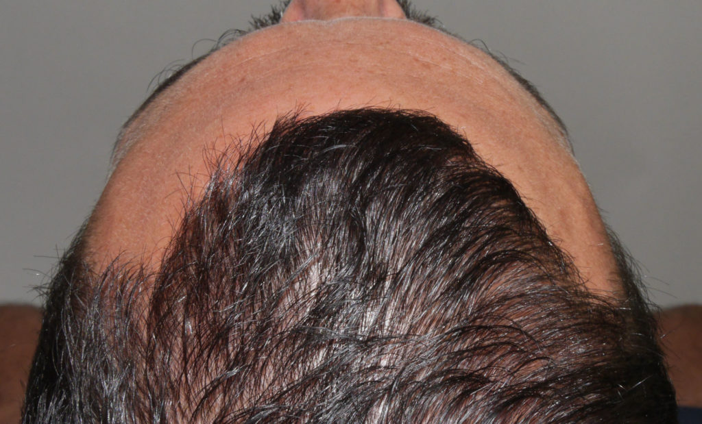 FUT Hair