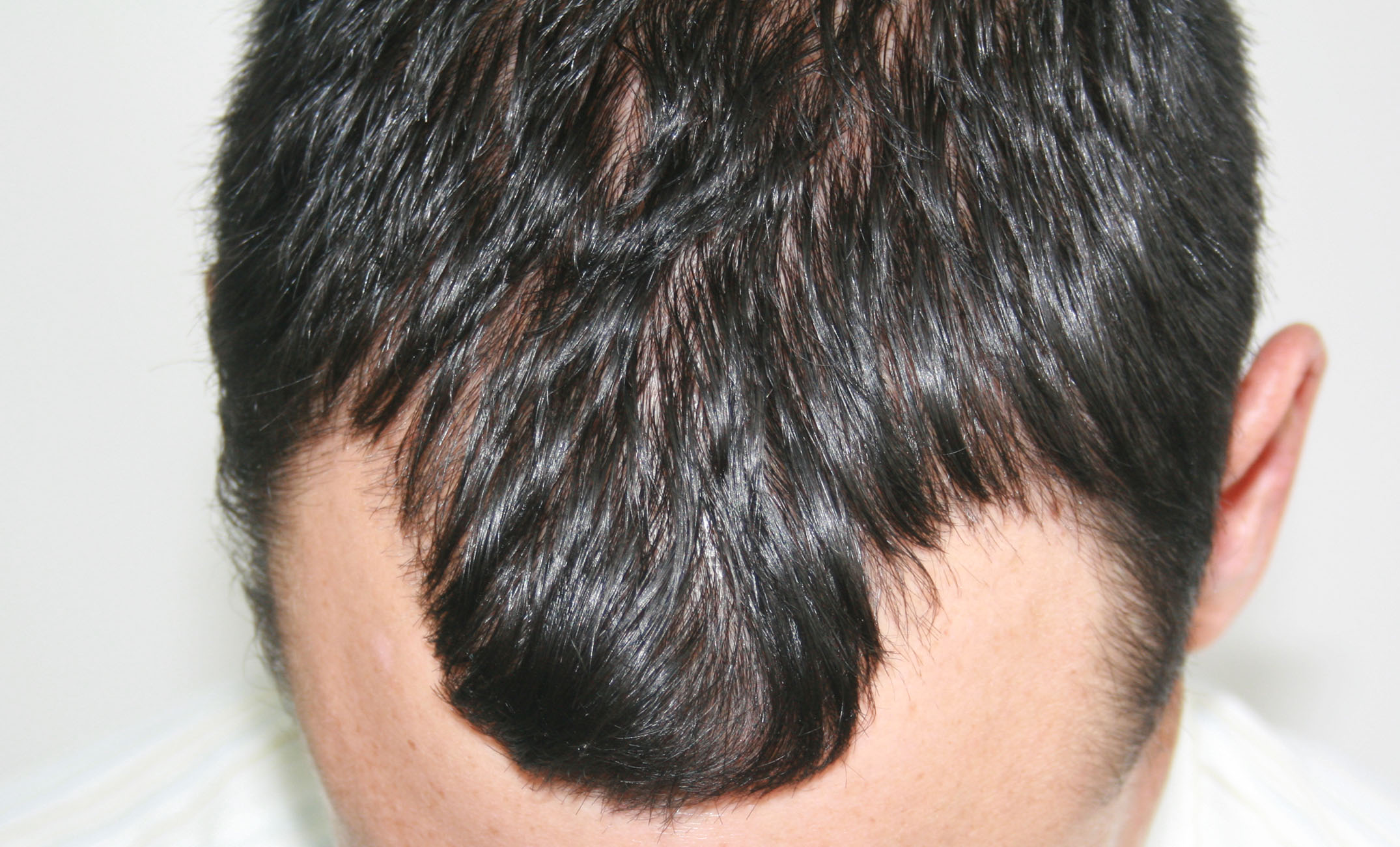 FUT Hair