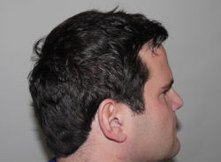 FUT Hair