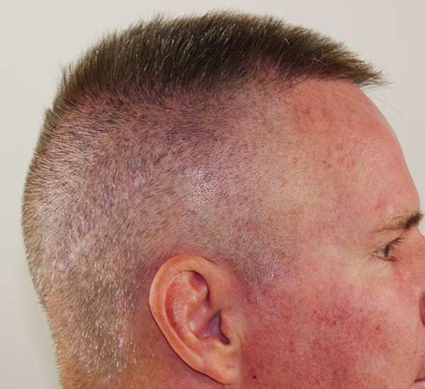 FUE (Follicular Unit Excision)