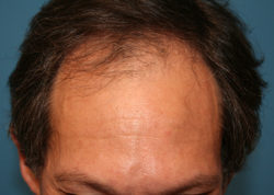 FUE (Follicular Unit Excision)