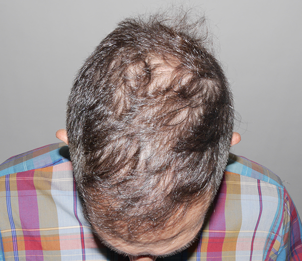 FUE (Follicular Unit Excision)