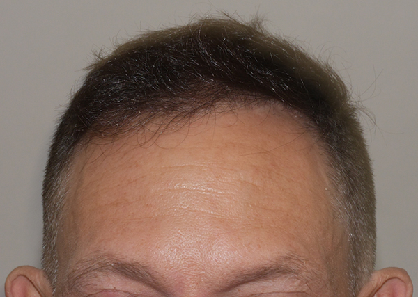 FUE (Follicular Unit Excision)