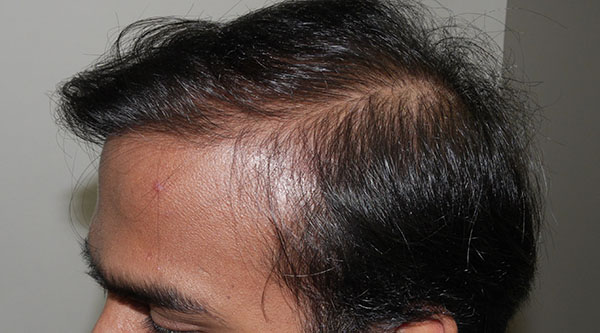 FUT Hair