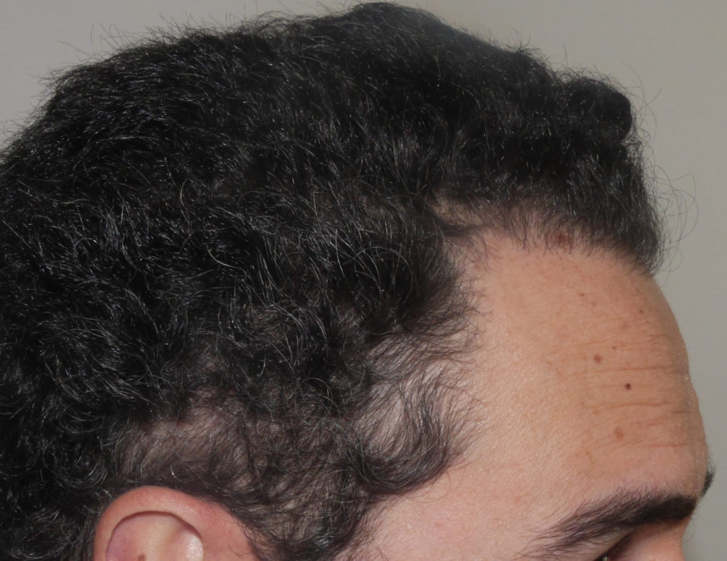 FUT Hair