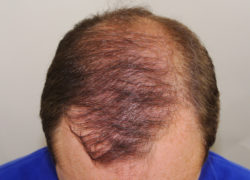 FUT Hair