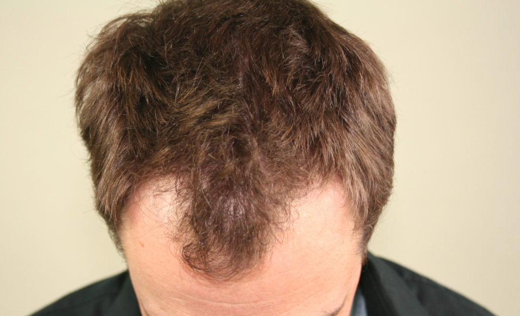 FUT Hair