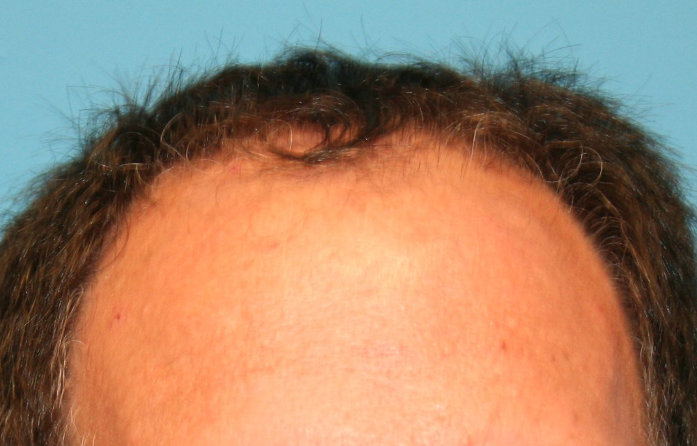 FUT Hair