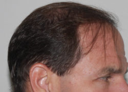 FUT Hair