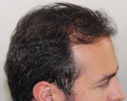 FUT Hair
