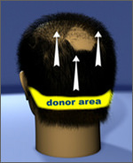 hair donor area