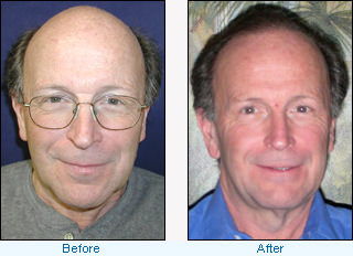 Hair Transplant Before and After - Wayne K