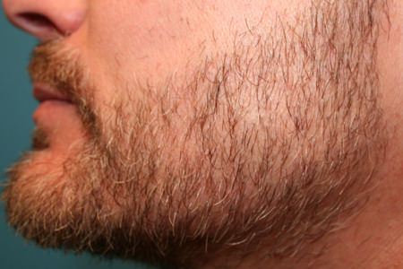 Before & After Beard Transplant - Left