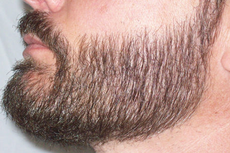 Before & After Beard Transplant - Left