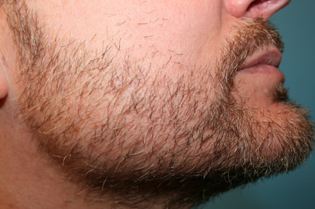 Before & After Beard Transplant - Right
